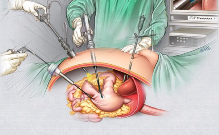 Лапароскопическая операция при поражениях желудка