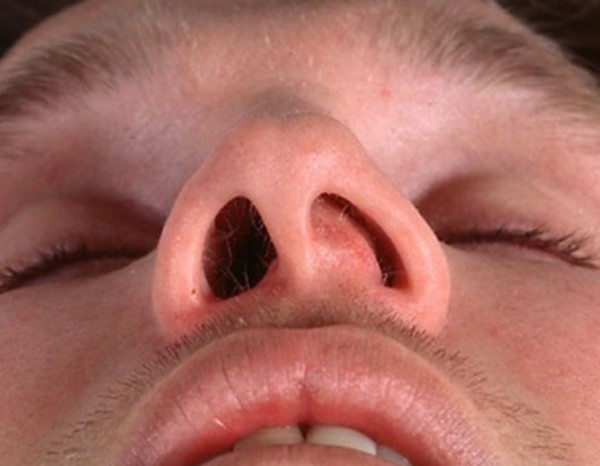 Асимметрия носа
